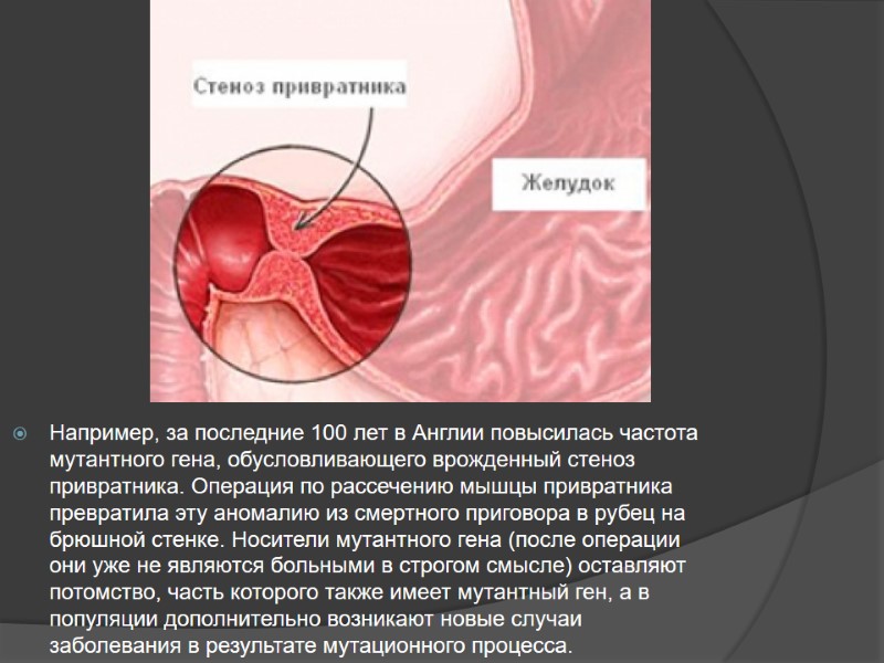 Например, за последние 100 лет в Англии повысилась частота мутантного гена, обусловливающего врожденный стеноз